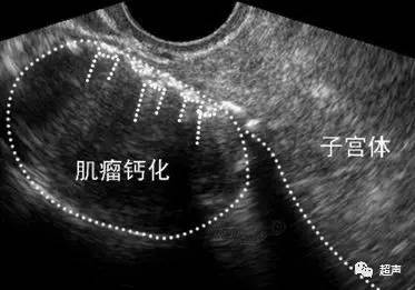 做供卵赠卵试管代生囊胚如何分级-做供卵试管婴儿助孕囊胚如何分